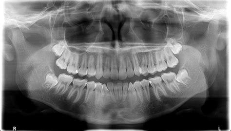 Dental X-Rays: How and Why We Need to See Beyond the Teeth