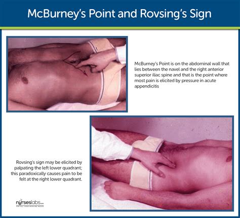 McBurney's Point and Rovsing's Sign | Emergency nursing, Medical school essentials, Nursing ...