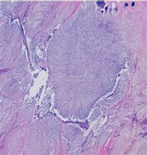 Gouty Tophus: Cytological Findings in a Case Diagnosed by Fine Needle ...