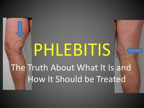 Phlebitis : Causes, Symptoms, Treatment And Surgery