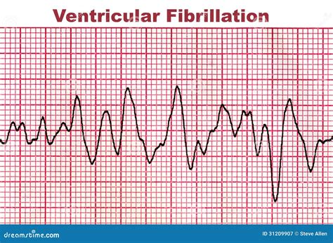 Fibrilación Ventricular - Arritmia Mortal Del Corazón Stock de ilustración - Ilustración de ...