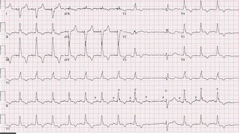 decidir Estrecho de Bering Furioso trifascicular block prognosis dramático micrófono Garganta