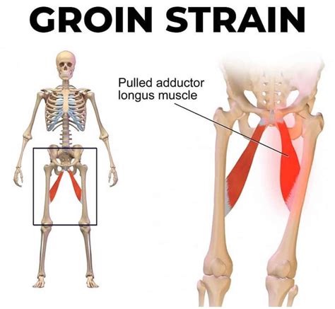 Groin Strain - Motus Physical Therapy