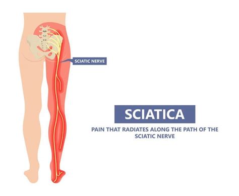 Unlocking the Mystery of Sciatica: Say Goodbye to Nerve Pain!: Remi Ajiboye, MD, MPH: Minimally ...