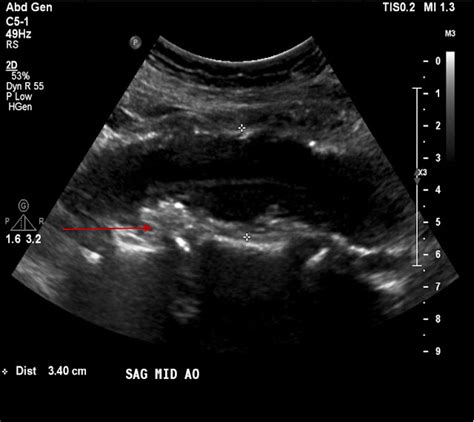 MEDICAL ULTRASOUND/ANEURYSM OF ABDOMINAL AORTA