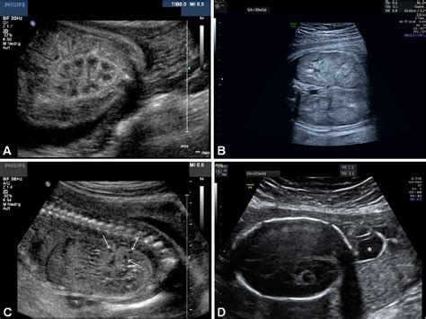 Fetal Polycystic Kidney Disease - Captions Beautiful