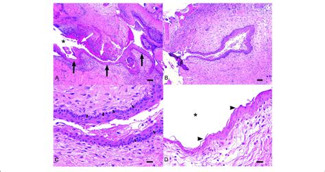 | Histologic representation of a typical dentigerous cyst from one of... | Download Scientific ...