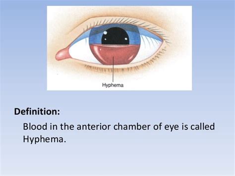 Hyphema