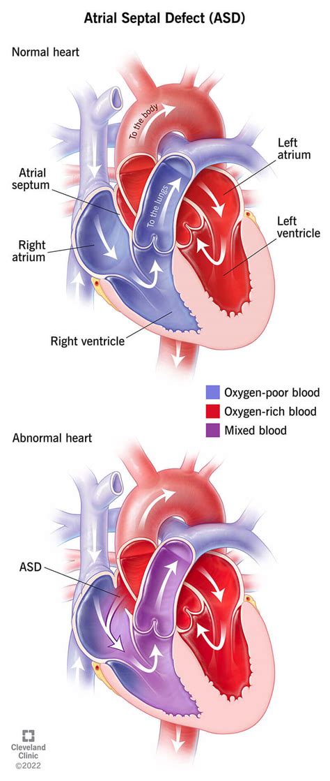 Atrial Septal Defect (ASD): Symptoms, Causes and Treatment