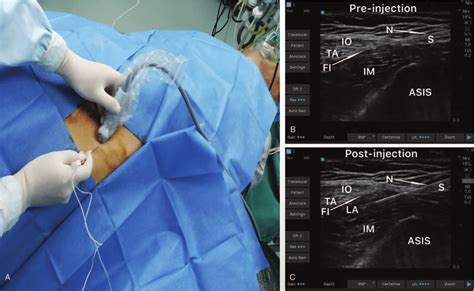 Ultrasound-guided suprainguinal fascia iliaca block. A: Final... | Download Scientific Diagram