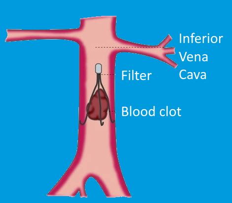 Superior Vena Cava Filter