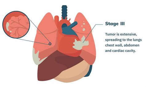 Stage 3 Mesothelioma | Treatment Options and Prognosis