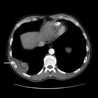 CT scan of the chest without contrast showed a heterogeneous mass in the | Download Scientific ...