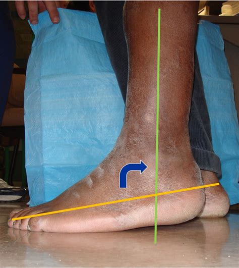 equinus foot ankle contracture — Foot & Ankle Surgery