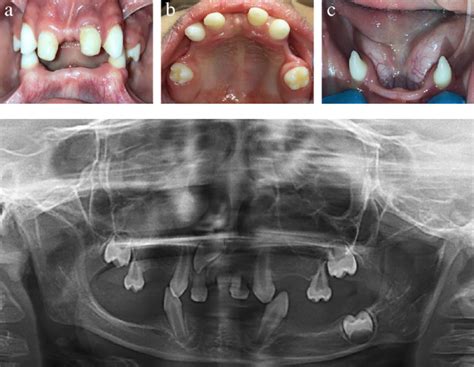 Management Of Ectodermal Dysplasia – Morning Huddle