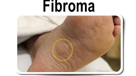 Plantar Fibromas - Friendswood, Lake Jackson, Bay City TX - Podiatrist ...