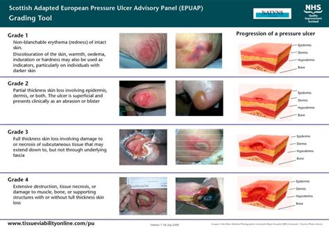 Image result for pressure sore grading | Wound care nursing, Wound care, Burns nursing