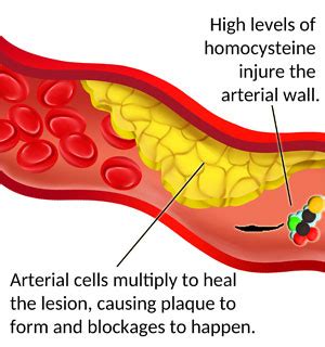 Homocysteine and Your Risk for Heart Disease