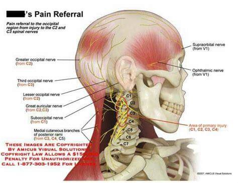 Third Occipital Nerve Headache - Headache