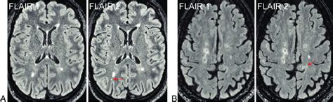 Examples of new punctate lesions (arrows) on longitudinal FLAIR images... | Download Scientific ...