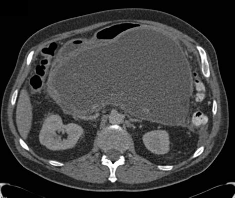 Large Pseudocyst in Lesser Sac due to Pancreatitis - Pancreas Case Studies - CTisus CT Scanning