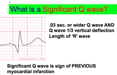 Significant Q wave