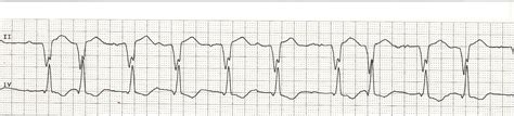 EKG Rhythm Strip Quiz 59