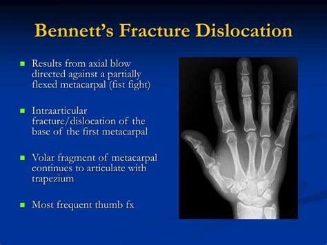 Bennett Fracture