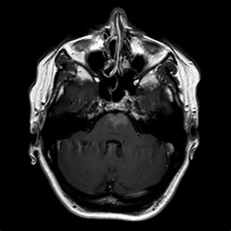 Capillary telangiectasia - large | Radiology Case | Radiopaedia.org