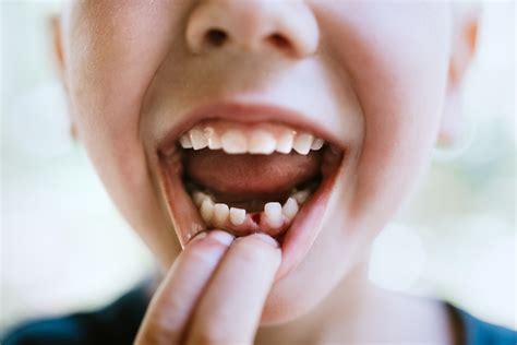 What Happens When Your Baby's Teeth Fall Out Too Soon? | CariFree