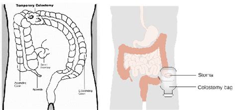 Reversing My Colostomy One Year After (Ostomy Reconnect) | HubPages