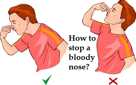 How to Stop a Bloody Nose?