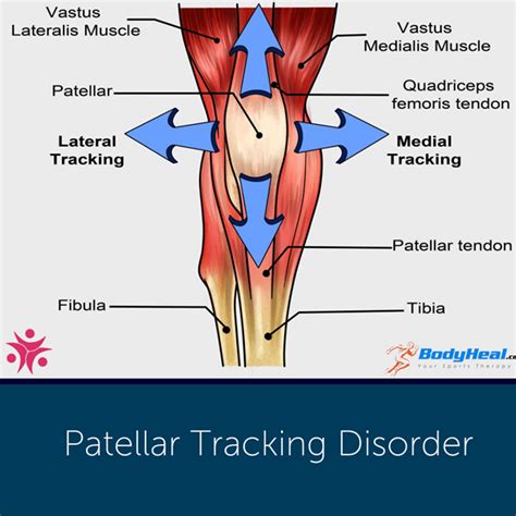 The Ultimate Guide To Patellar Tracking Disorder