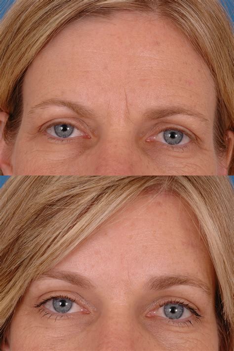 Botox Before & After Photos | Benjamin Bassichis MD, FACS