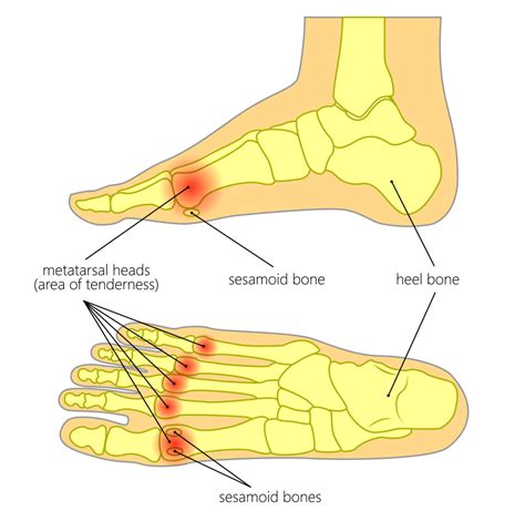 Metatarsal pain: Metatarsalgia - Marie Whitfield Podiatry | Ball of ...