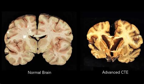 Know Your Brain: Chronic Traumatic Encephalopathy (CTE)