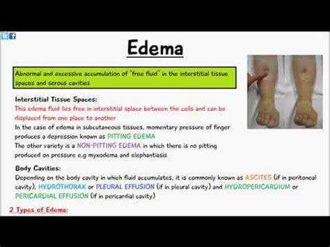 Pathology Lectures Edema Pitting Non Pitting Edema Transudate Exudate - YouTube