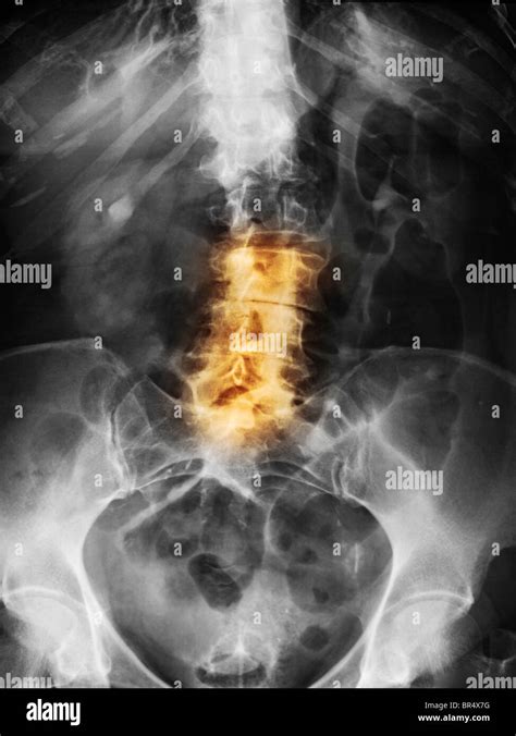 Degenerative Lumbar Spine X Ray