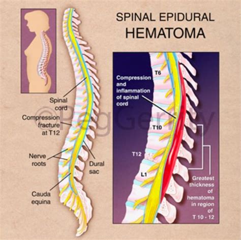 Epidural Hematoma Spine