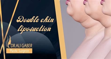 Double chin liposuction surgery procedure and recovery