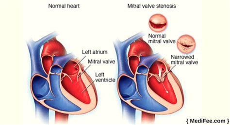 Mitral Valve Stenosis Ultrasound