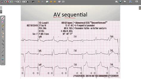 Ventricular Paced Rhythm