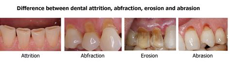 What is the difference between dental attrition, abfraction, erosion and abrasion? | News ...