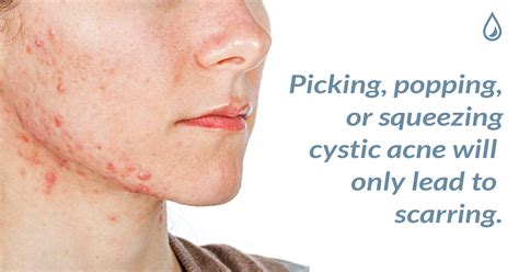 Roku Gift: Cystic Acne On Jawline And Neck