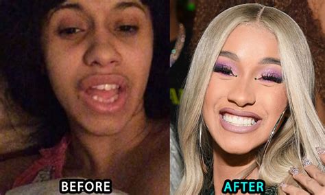 Cardi B Plastic Surgery, New Teeth, Boob Job, Butt Injections, Before ...