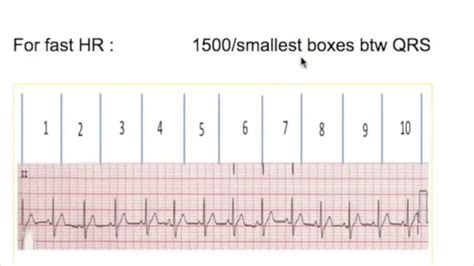 How To Calculate Heart Rate From Ecg With Irregular Rhythm - Photos Idea