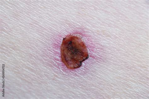 healing wound with scab after basal cell skin cancer laser treatment ...