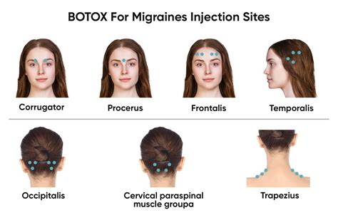 BOTOX For Migraines Bellevue & Kirkland | Best BOTOX Bellevue