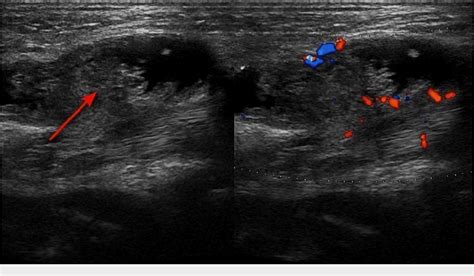 Figure 2 from Lipoma Arborescens Where MRI Is a Boon | Semantic Scholar