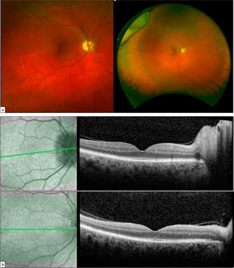 Optos and OCT from the time of diagnosis versus three weeks after ...